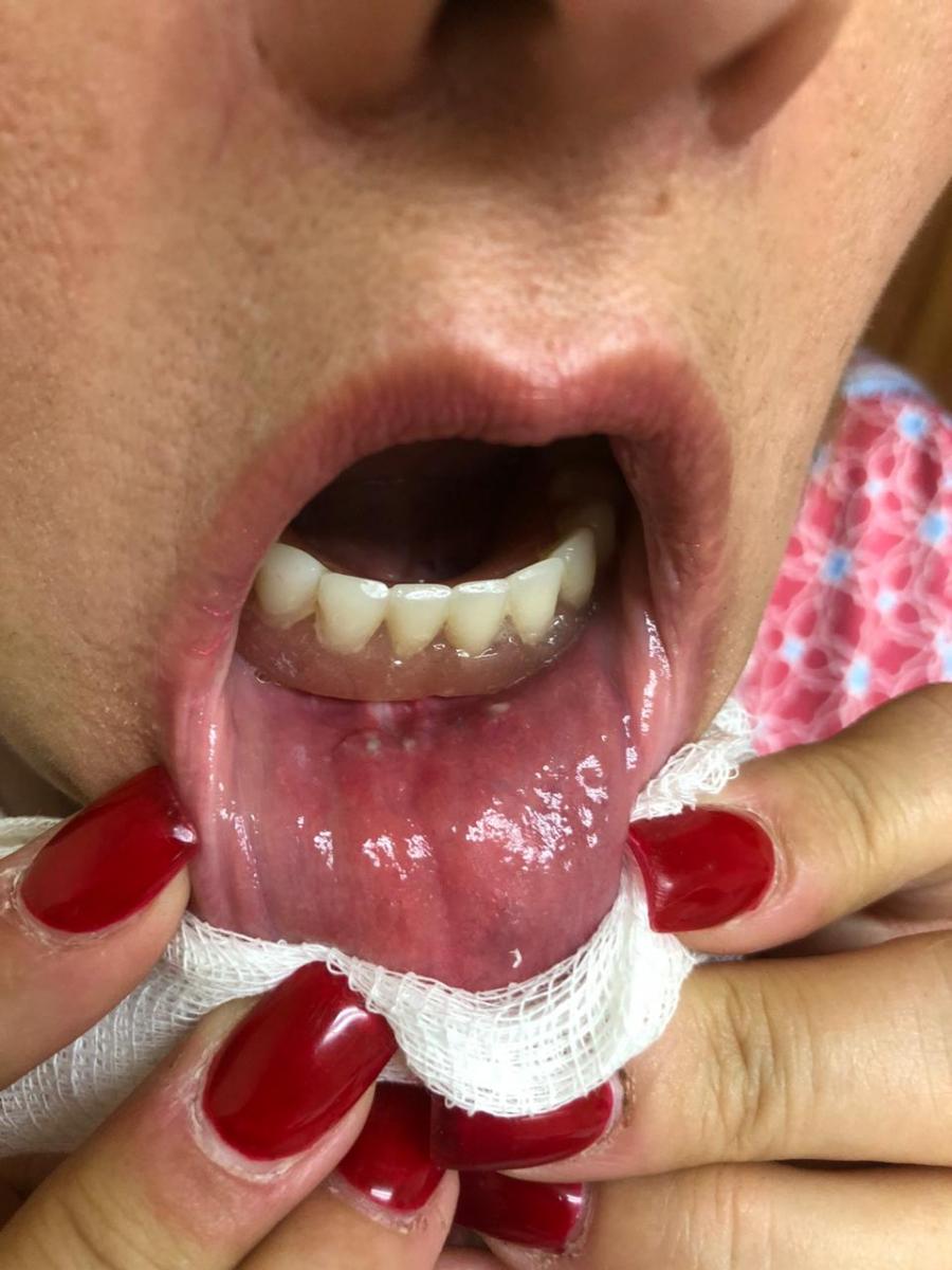 Gilda Chavez , paciente tratada de tiroidectomía total por la boca SIN CICATRIZ