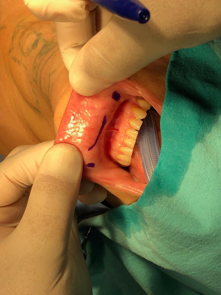 Berenice Ramos Santana, 34 años, Cirugía tiroidea por la boca (TOETVA) SIN CICATRIZ